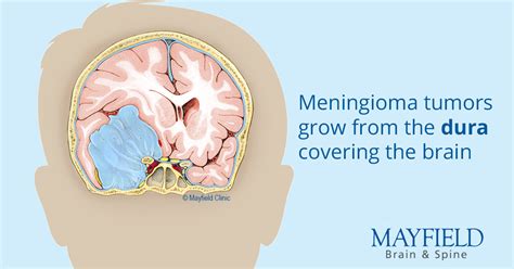 Meningioma Brain Tumor Meningioma Treatment Options Mayfield Brain