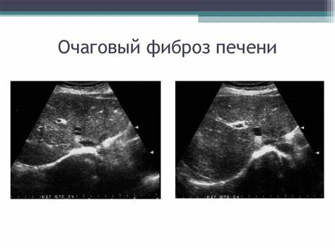 Цирроз печени диета 1 Цирроз Печени Узи Фото — Фото Картинки Цирроз Печени Узи Фото — Фото Картинки Цирроз печени диета 1