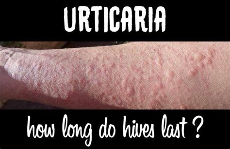 How Long Do Hives Last After An Allergic Reaction Allergic Reaction