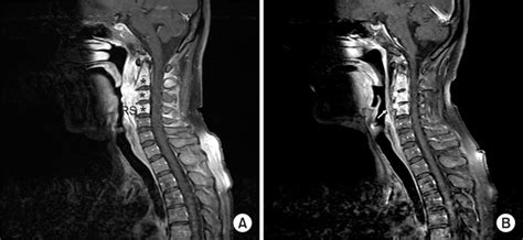 A Contrast Cervical Spine Mri A Contrast Enhanced Sagital