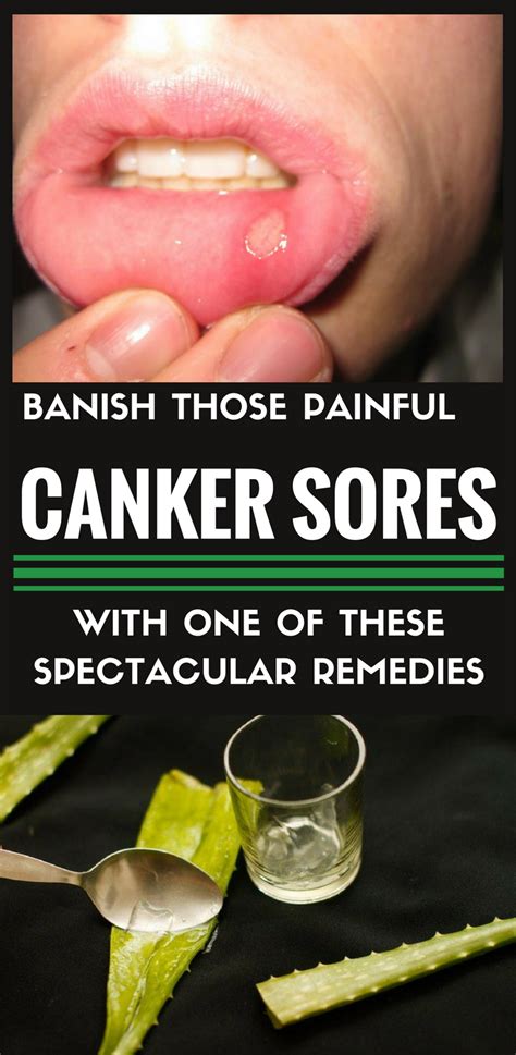 Home Remedies For Canker Sores Inside Lip Home Sweet Home Insurance