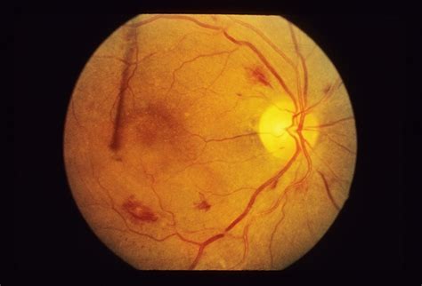 Hypertensive Retinopathy Retina Image Bank