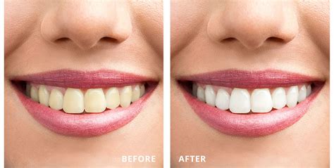 Win A Free Teeth Whitening Northgate Dental