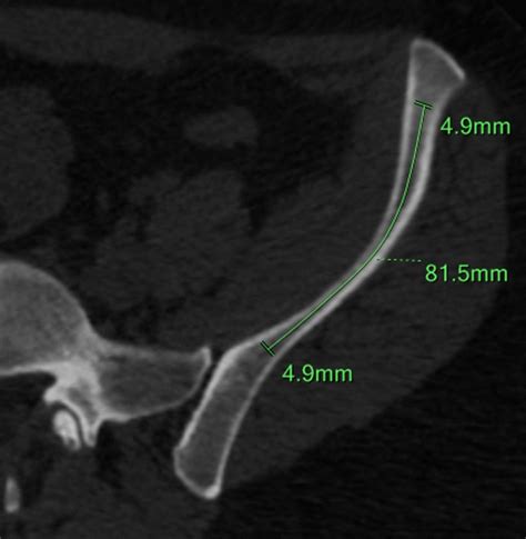 An Axial Ct Cut Of The Left Iliac Wing At The Level Of The Asis And