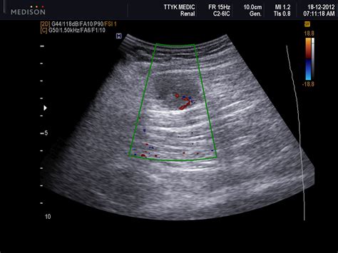 Vietnamese Medic Ultrasound Case 159 Intramuscular Mass Dr Phan