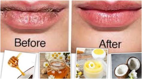 Chapped Lips Problem Use These Homemade Scrubs To Make Them Smooth And