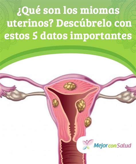 Qu Son Los Miomas Uterinos Desc Brelo Con Estos Datos Importantes