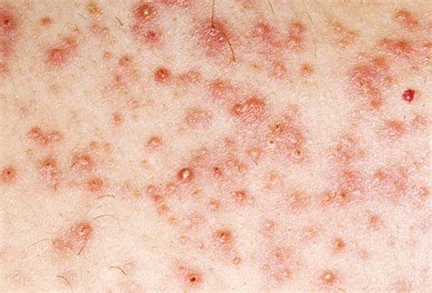 Some could be caused due to problems within the body while some could be contracted externally such as groin rashes caused by stds (sexually transmitted diseases). Rashes, Bumps, and Lumps Below The Belt