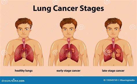 Informative Illustration Of Lung Cancer Stages Stock Vector