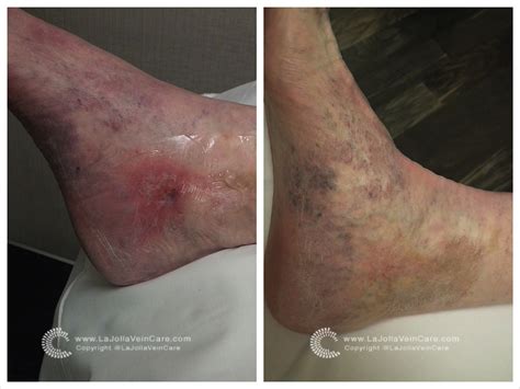 Chronic Venous Insufficiency And Leg Ulcers La Jolla Vein Vascular Accredited Center
