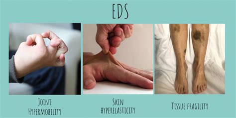 Ehlers Danlos Syndrome Compleo Waco LLC