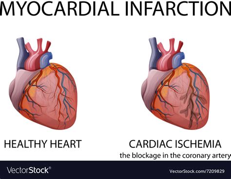 Myocardial Infarction Photo