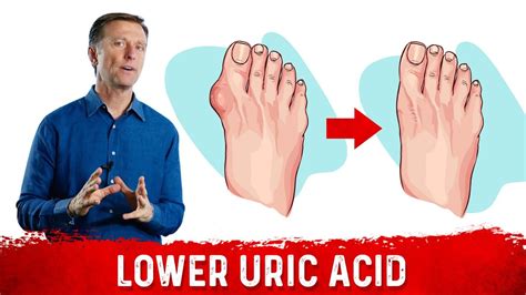 Ways To Neutralize Uric Acid Youtube