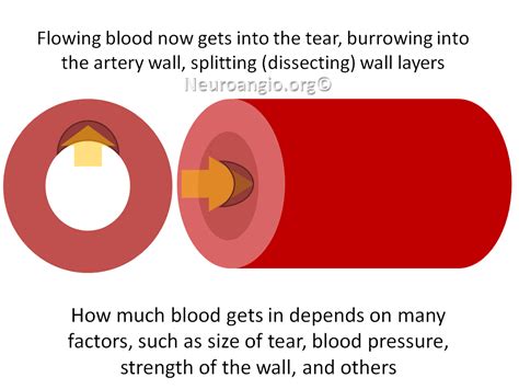 Arterial Dissection — Carotid Vertebral Basilar Arteries