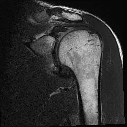 Proximal Biceps Tendon Injury Radiology Reference Article Radiopaedia Org