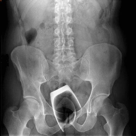 Transanal Removal Of A Broken Drinking Glass Self Inserted And Retained In The Rectum Bmj Case