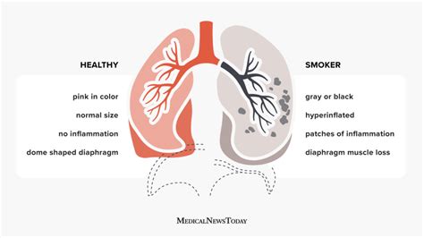 Smokers Lungs Vs Healthy Lungs Facts Pictures And More