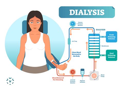 Dealing With Dialysis While Living With Lupus Kaleidoscope Fighting Lupus