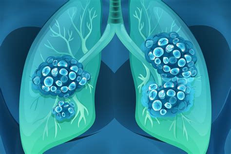 Lung Cancer Among Lifetime Never Smokers On The Rise Medpage Today