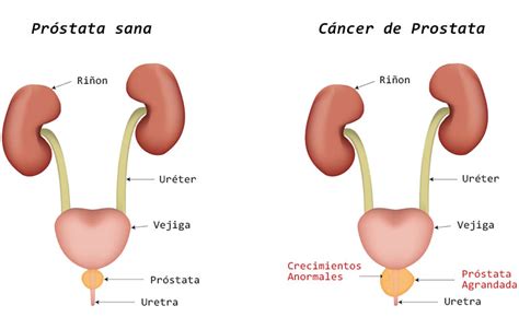 Cáncer De Próstata Urología Clínica Bilbao
