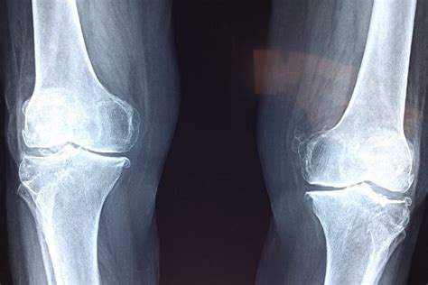 Total Knee Replacement Treatment For Patients With Knee Osteoarthritis