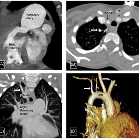Ct Angiography Multiplanar Reconstruction In Right Ventricular Outflow