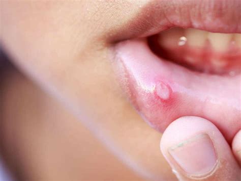 Sore Tongue Causes Of A Sore Tongue