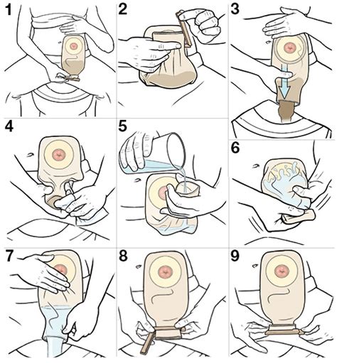 Step By Step Stoma Care Emptying The Pouch