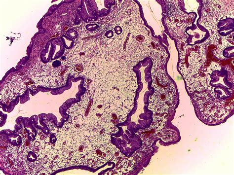 gastrointestinal and liver histology pathology atlas stomach hyperplastic polyps