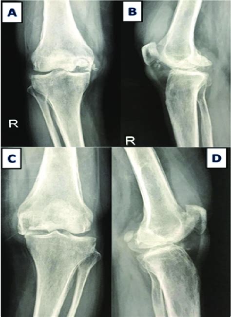 A X Ray Right Knee Anteroposterior View Showing Large Osteochondral