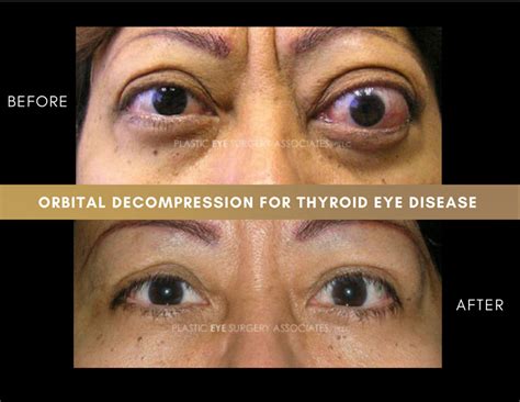 Thyroid Eye Disease Photos Plastic Eye Surgery Associates