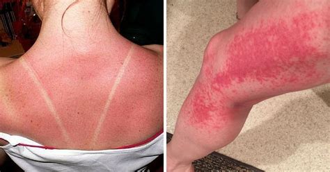 So, sun poisoning isn't a formal medical term, but it's a common way for patients to describe a scenario where they experience a severe sunburn. 5 Signs Your Sunburn Is Actually Sun Poisoning