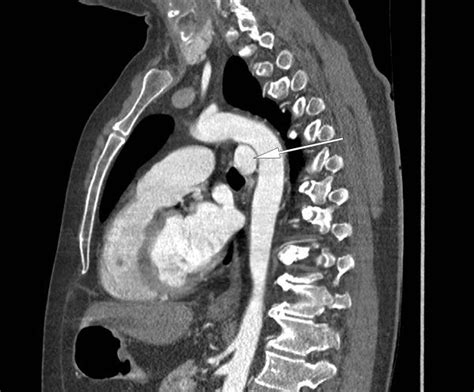 Aberrant Left Pulmonary Artery As Seen On A Sagittal Ct Normal Variant
