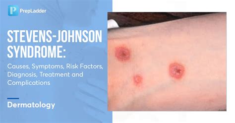 Stevens Johnson Syndrome Causes Symptoms Risk Factors Diagnosis