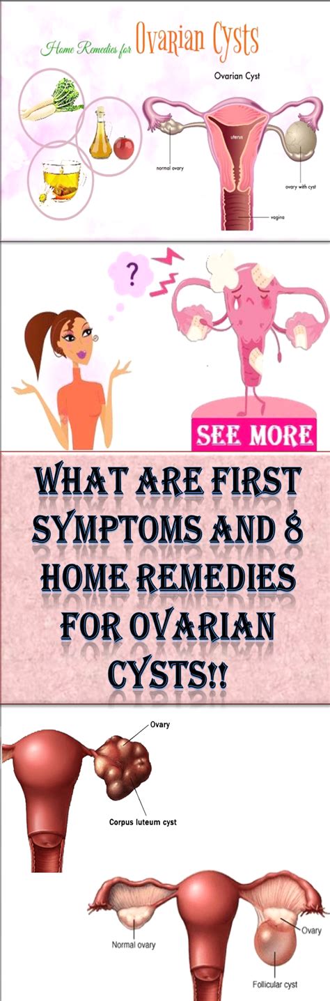 What Are First Symptoms And 8 Home Remedies For Ovarian Cysts