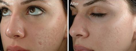 Derma Roller Before And After Photos Mgp Animation