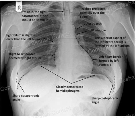 In fact every radiologst should be an expert in chest film reading. A normal PA chest X-ray demonstrating the normal anatomy. | Download Scientific Diagram