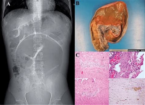 A Sigmoid Volvulus B Surgical Specimen C Histology Increased