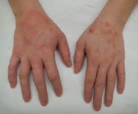 Dermatitis Wikipedia