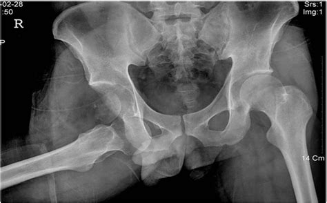 Anterior Obturator Hip Dislocation Concurrent With Vertical Shear Fracture Of Femoral Head