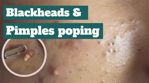 Blackheads And Pimples Popping Youtube
