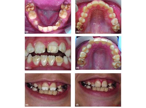 Examples Of Clinical Presentations Of Molar Incisor Hypomineralisation