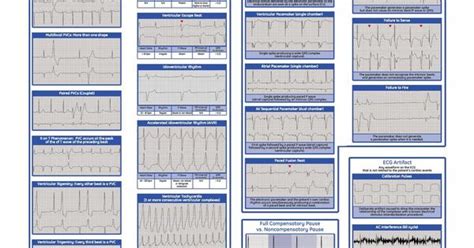 Arrhythmia Recognition Poster Nursing Cheat Sheets Pinterest This