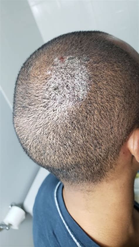 White Bumps On Scalp Images And Photos Finder