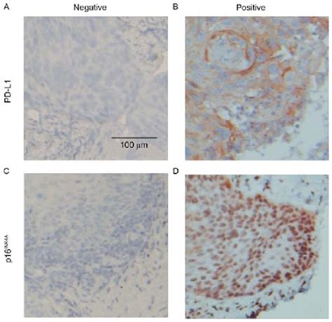 Immunohistochemical Staining Of Pd L1 And P16 Ink4a In Representative