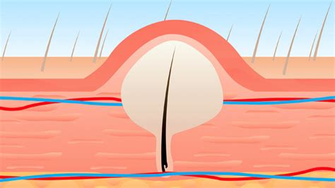 Treating And Preventing Ingrown Pubic Hair