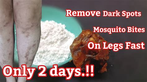 Only 2 Days Remove Dark Spots Mosquito Bites Scar