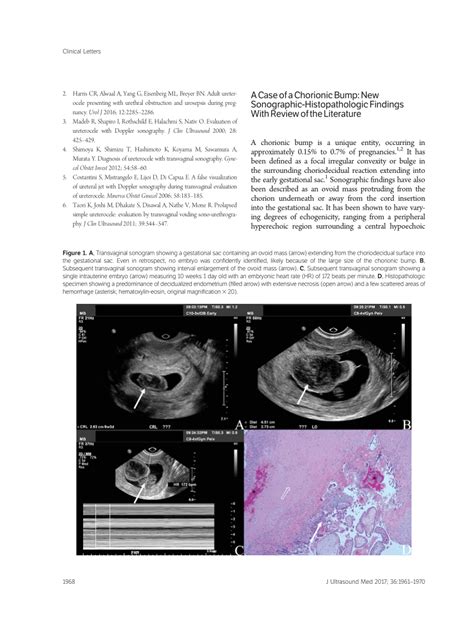 Pdf A Case Of A Chorionic Bump New Sonographic Histopathologic