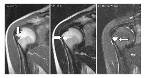 Figure From Intraosseous Ganglion Cyst Of The Humeral Head In A Competitive Flat Water Paddler