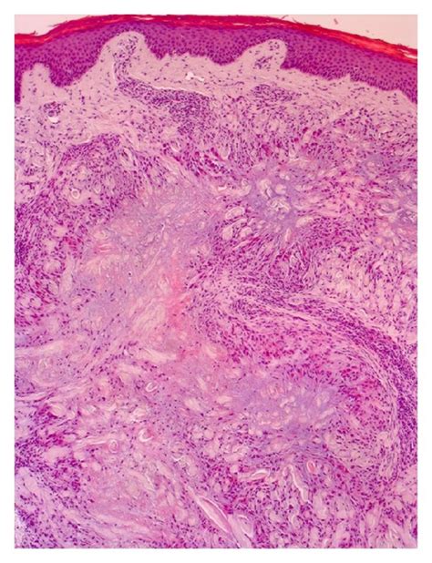 Normal Epidermis Palisaded Granulomas Of Dermis With Epithelioid